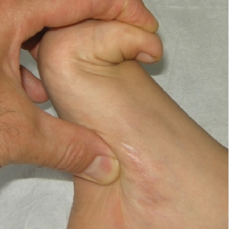 Pioneer Podiatry - Joint Hypermobility