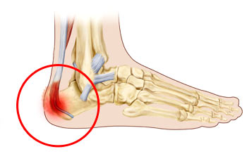 heel bone pain running