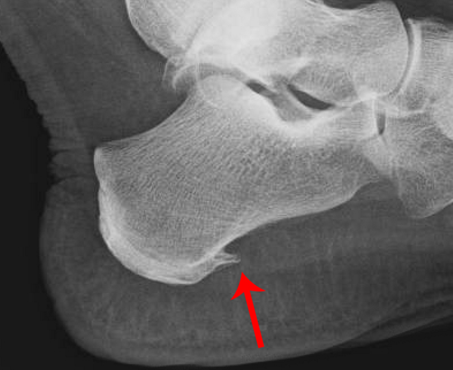 A Heel Spur May Be Misdiagnosed