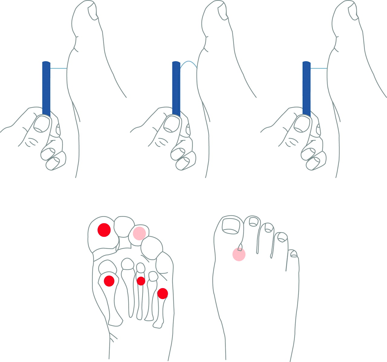 5.07 Monofillament for testing for peripheral neuropathy