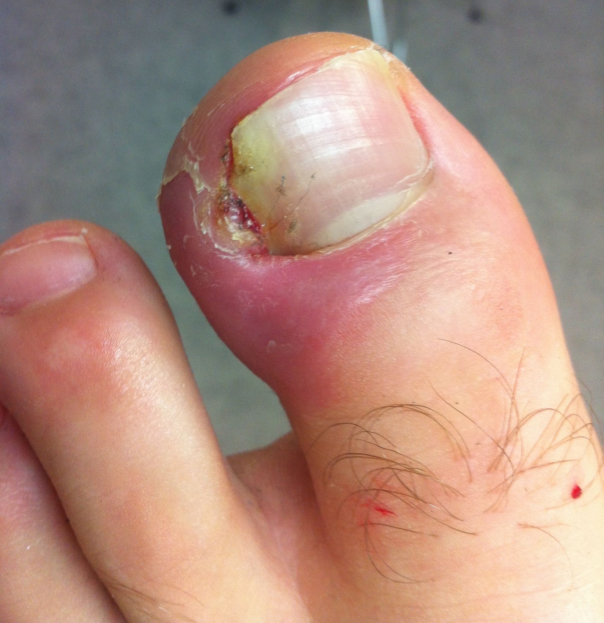 Around a month after toenail removal surgery. Does the skin look normal? :  r/Ingrown_Toenails