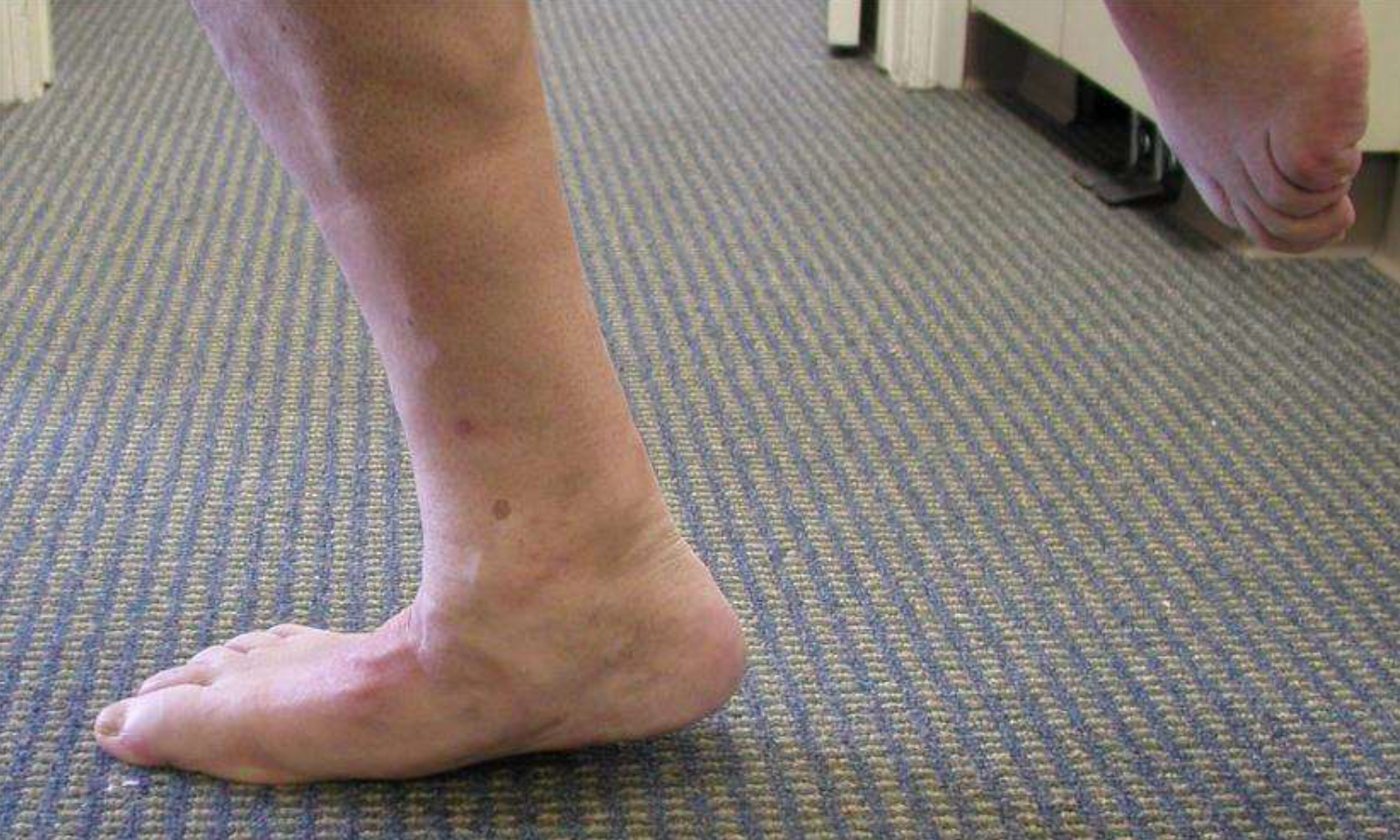 Failed single leg heel raise test. Note: Midfoot collapse and MT joint flexion.