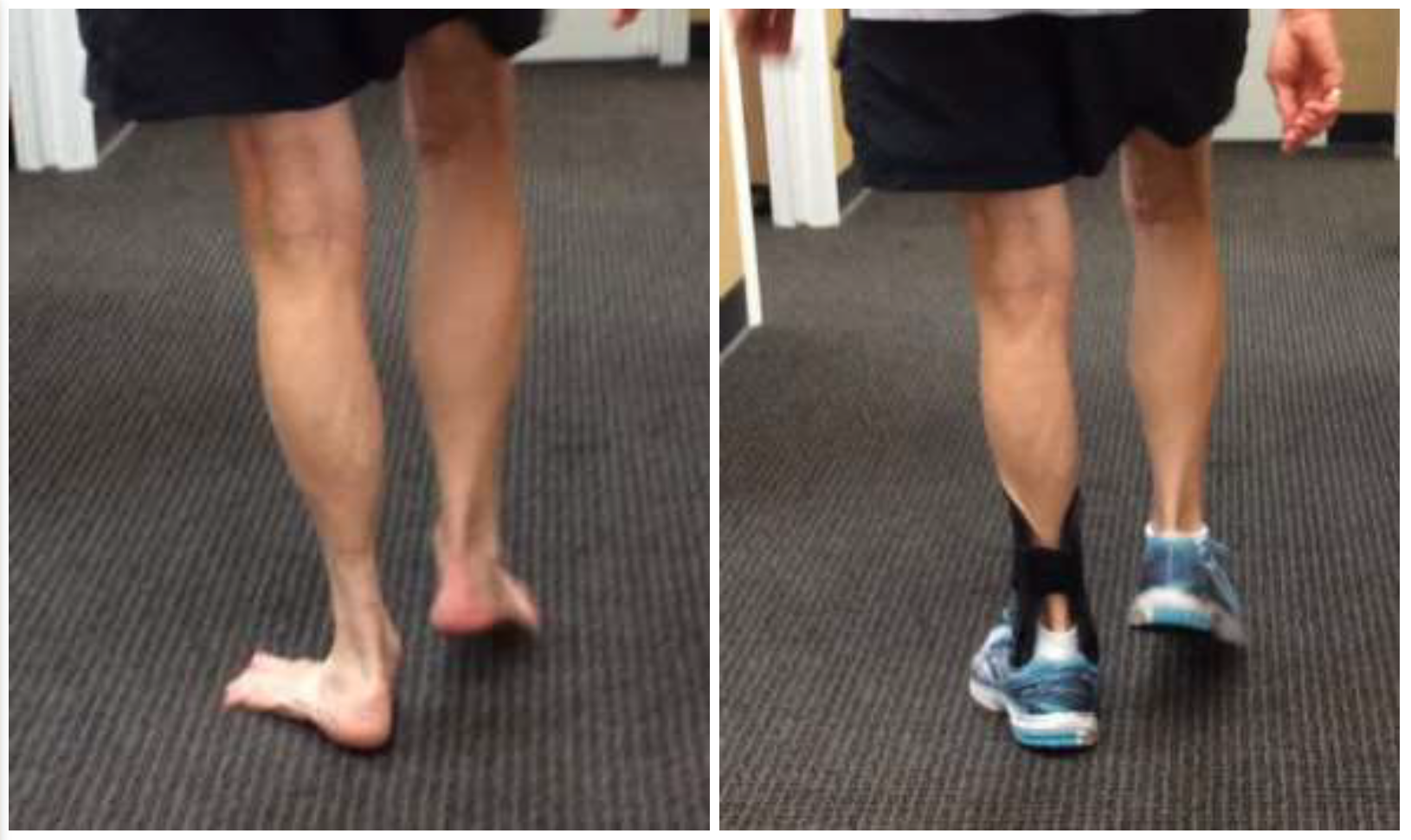 Gait analylis showing before and after fitting of custom AFO for left sided AAFF. Note: reduction of forefoot adduction, and calcaneal valgus. The gait parameters in this patient were drastically improved and much more symmetrical. 