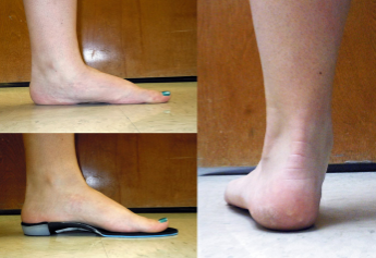 What is Acquired Adult Flat Foot?... How to help your patients avoid catastrophic foot surgery.   
