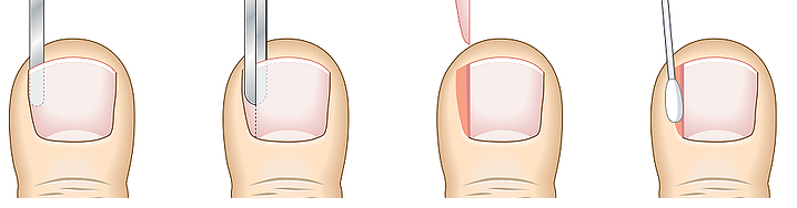 PNA surgery.png