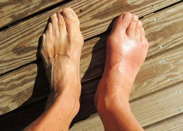 Is A Stress Fracture Serious? — Pioneer Podiatry