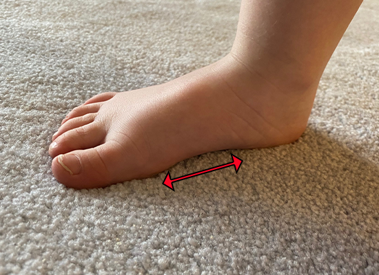Flat Feet in Children: Should you worry?