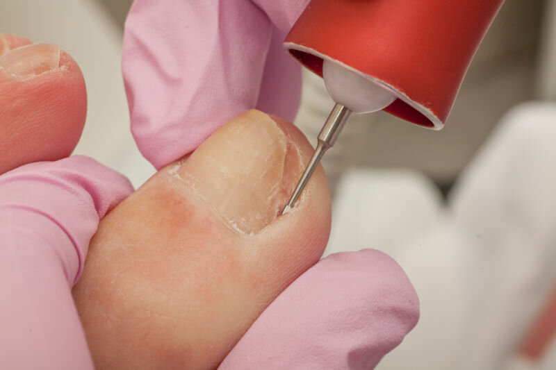 Are You Suffering From A Painful Ingrowing Toenail? — Pioneer Podiatry Are You Suffering From A Painful Ingrowing Toenail? — Pioneer Podiatry