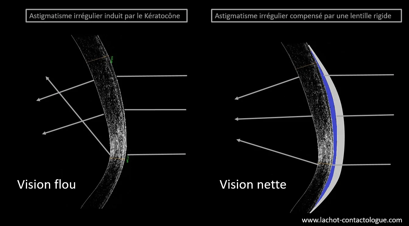 Pourquoi des lentilles rigides? — Christophe LACHOT Contactologue