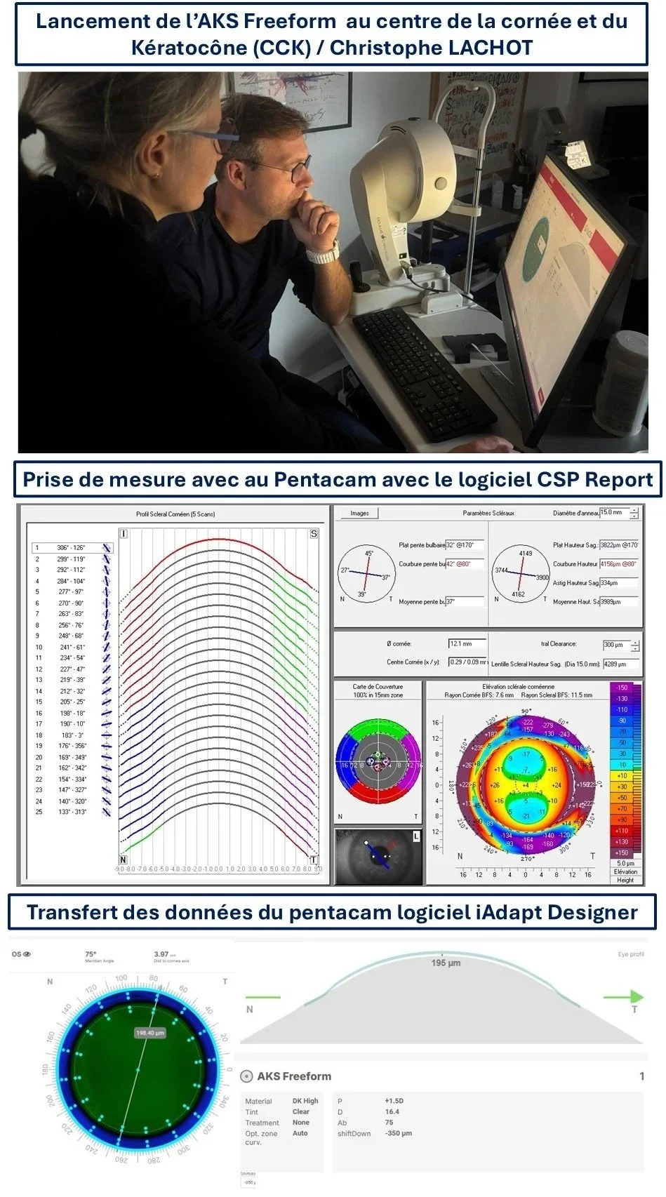 adaptation au centre de la cornée et du kératocône de la nouvelle lentille sclérale AKS Freeform, une lentille sur mesure à la forme de votre oeil