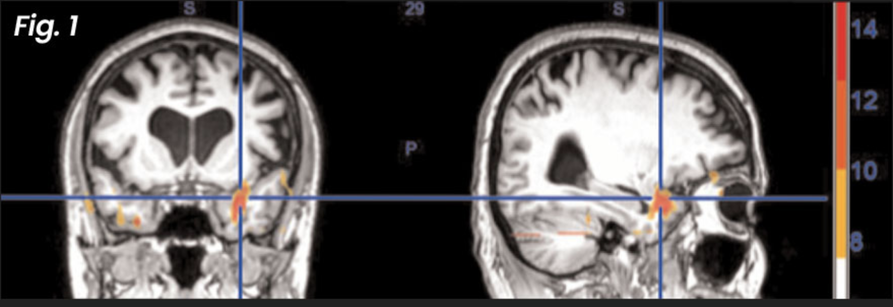 Figure 1: Before NET treatment — with these fMRI images we can actually see what the brain looks like during the re-experiencing of a past traumatic event (before a patient is treated with NET).