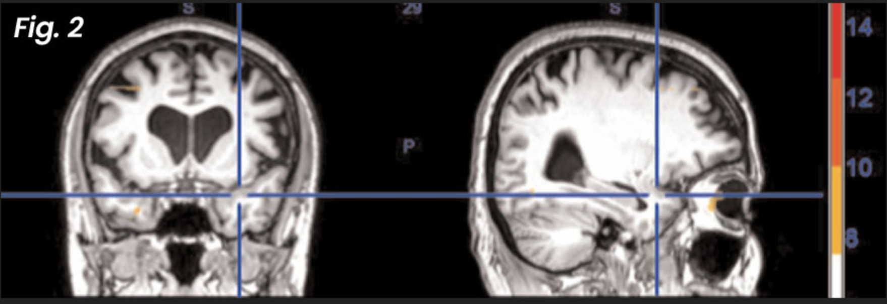 Figure 2: After NET treatment — these post-treatment fMRI images demonstrate how the brain has returned to normal healthy functioning as a result of the NET intervention — even when the patient is again exposed to the same information that was traumatic before treatment.