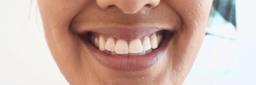 Smile Brilliant Review - At Home Whitening System