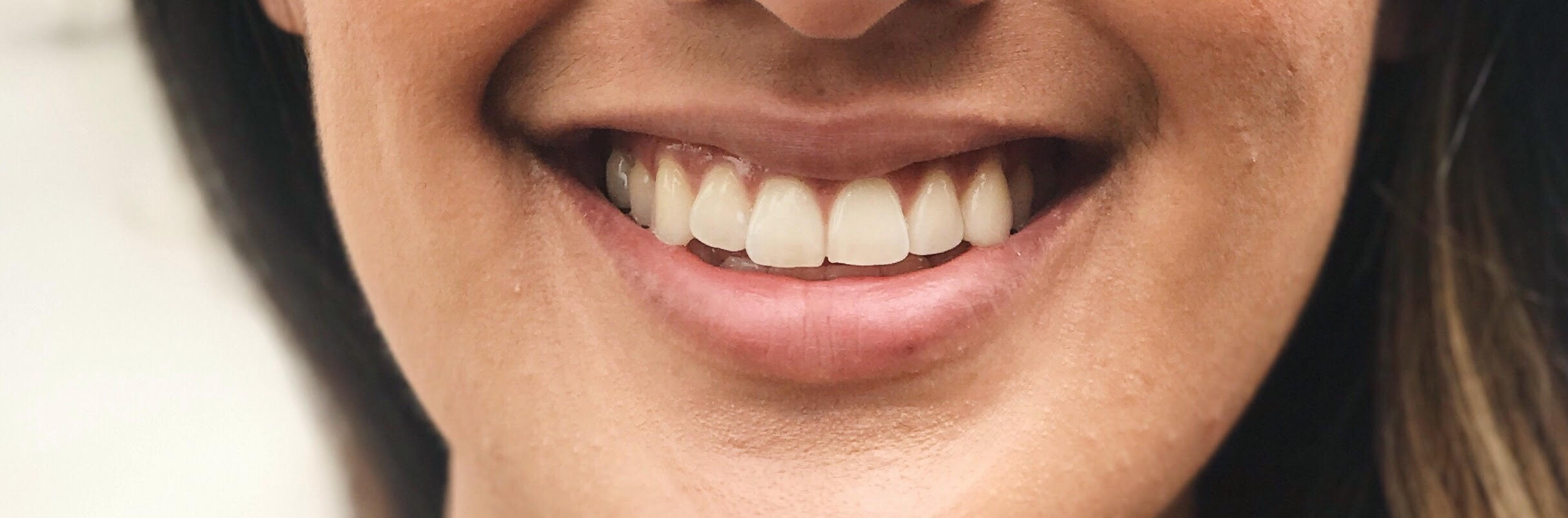 Smile Brilliant Review - At Home Whitening System