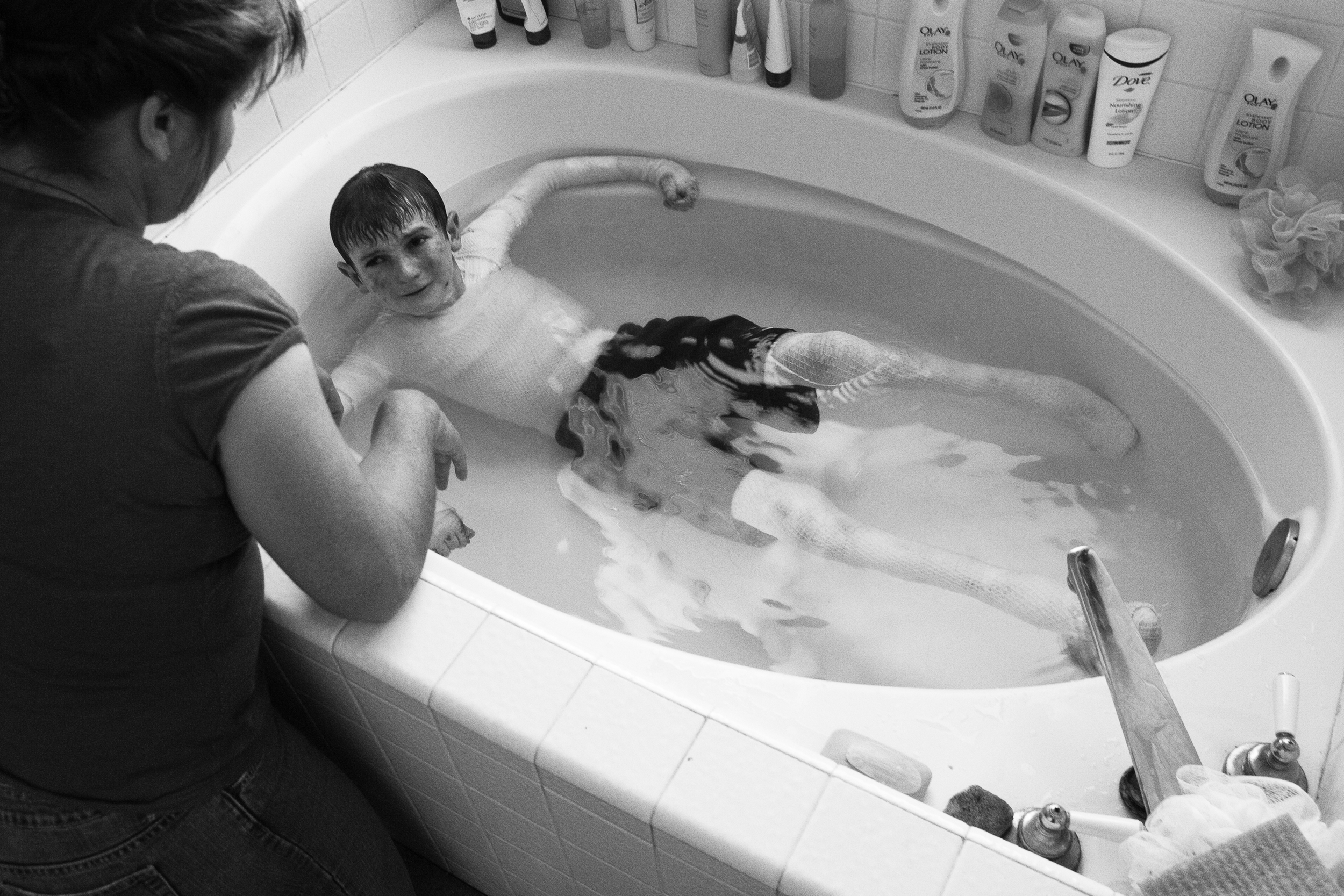  Garrett Spaulding, 12, holds on tightly to the side of the bathtub during a bandage soak. The jacuzzi is not working where he normally soaks so he must sit in the tub. Garrett is extremely afraid of the bathtub. Lorraine, his mom explains. (Credit I