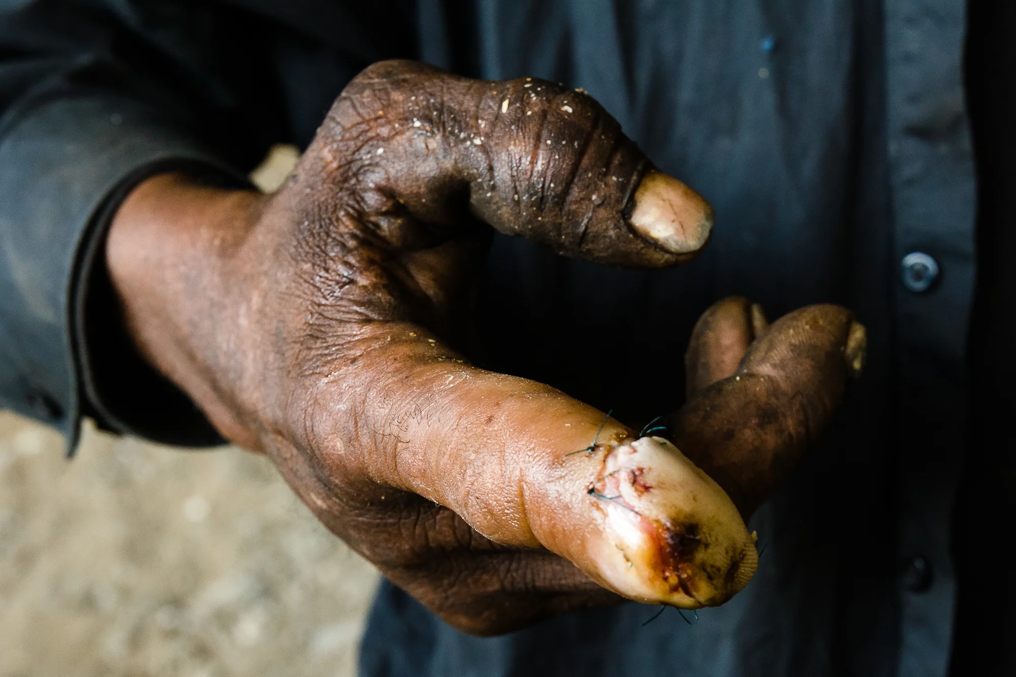 During a scrapping job in an abandoned factory, Boudreaux's finger was chopped off below the first joint. He was taken to the County hospital, where the surgeon did a hackneyed job of repairing his finger. Often is the case for the homeless at a county hospital.