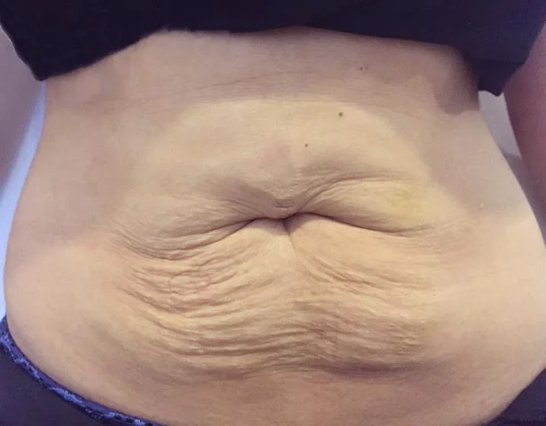 Before treatment