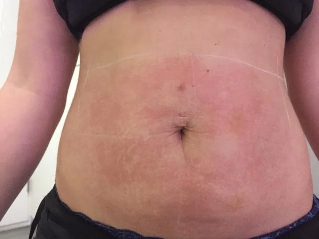After treatment