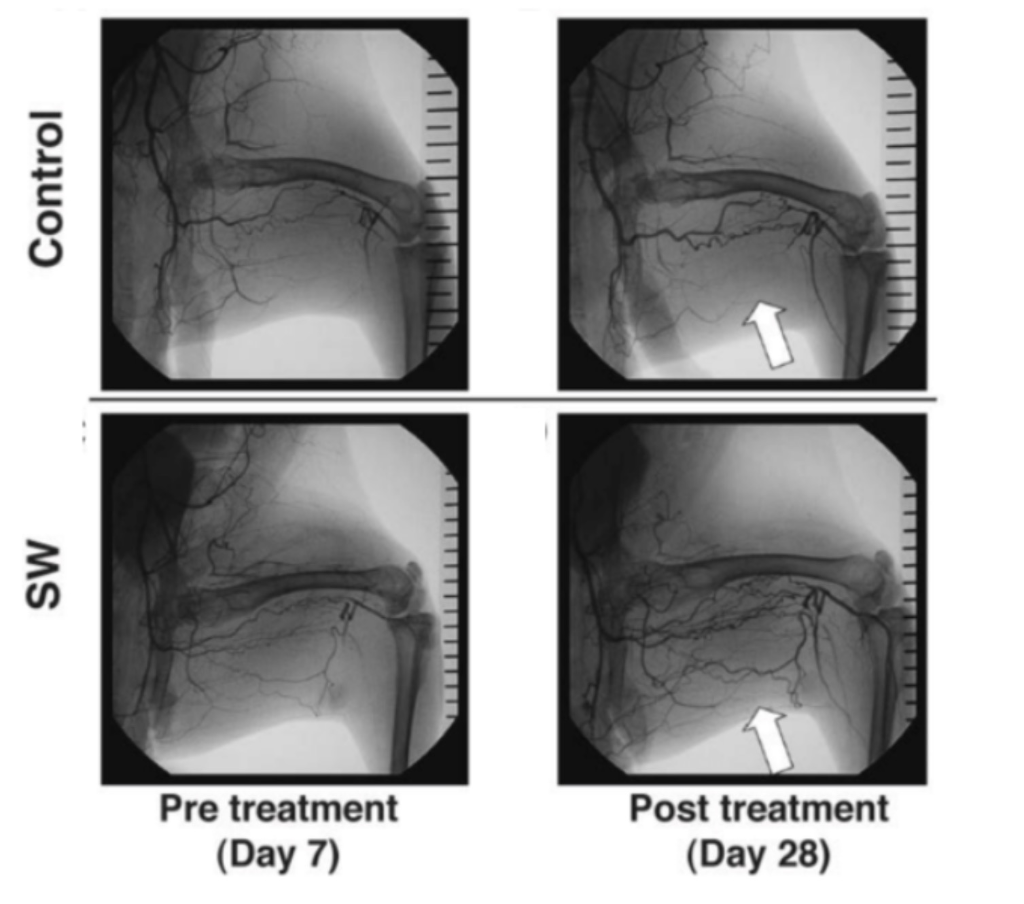 Angiographs showing the changes in patients treated with shockwave therapy (SW). In particular note the changes in blood vessel formation.