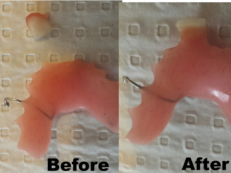Partial Denture Repair