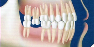 VERTICAL TOOTH MIGRATION