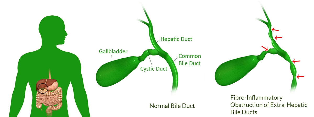 Human model diseases of interest to our studies of the mechanism of fibrosis include biliary atresia. We are part of an international group that has recently identified a plant toxin that causes biliary atresia. We have developed model mammalian cell systems to study its mechanism of action and are testing structurally similar compounds in an attempt to identify critical structural groups, which may lead us to compounds of relevance to humans. Additionally, as part of a general interest in biliary fibrosis, we are studying potential myofibroblast precursor populations in the extrahepatic bile duct, the impact of acute vs. chronic cholangiocyte injury, mechanisms of liver fibrosis post bile duct obstruction, and differences between intra- and extra-hepatic cholangiocytes.