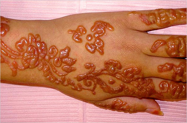 Black chemical 'henna' caused severe blistering and will leave a permanent scar on this person