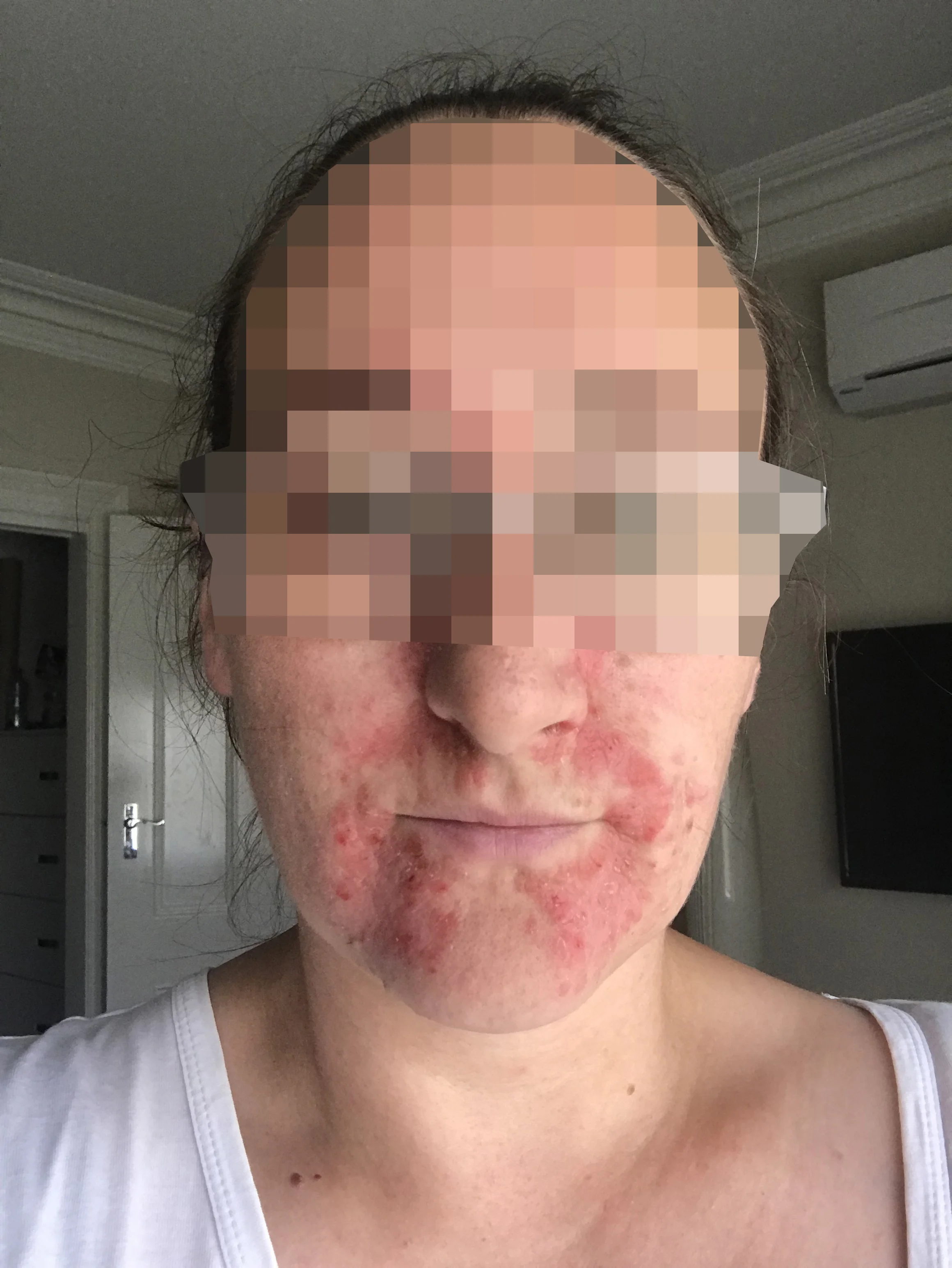 2 Cryotherapy for skin condition.jpg