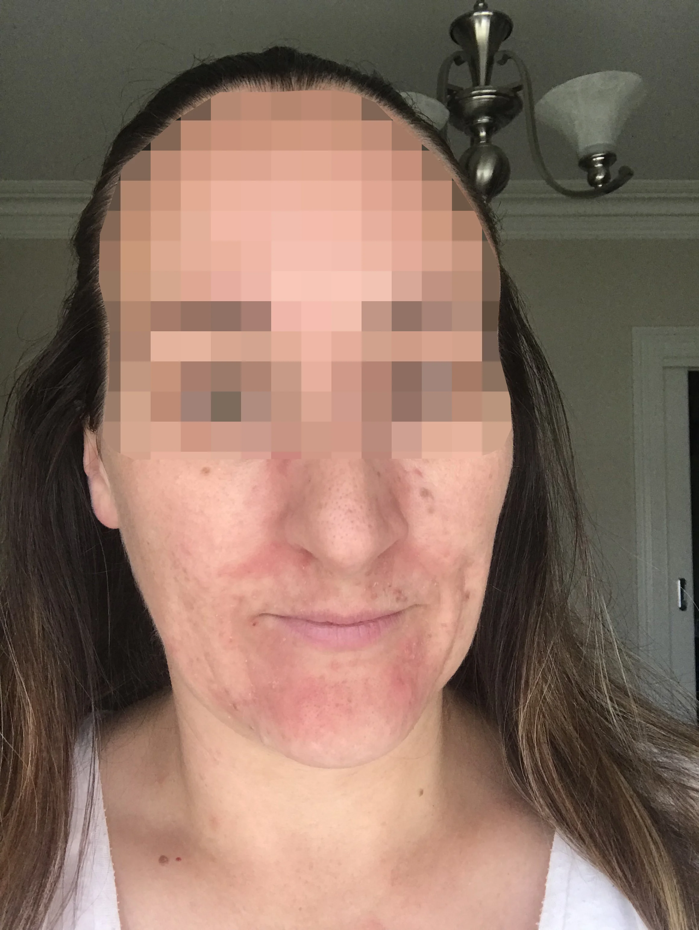 5 Cryotherapy for skin.jpg