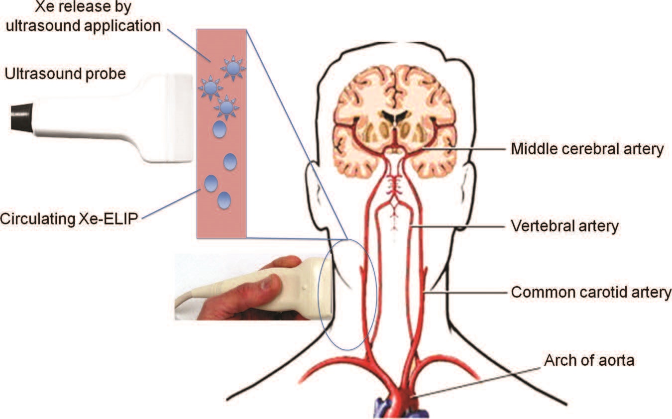 Xe-ELIP can be infused intravenously and ultrasound applied over the common carotid artery for ultrasound-triggered priminary Xe release from circulating Xe-ELIP into the brain .