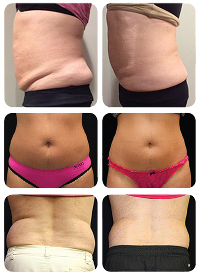 This is a fat removal system not a weight loss program. For large or small weight loss see our nutrition and fitness services.