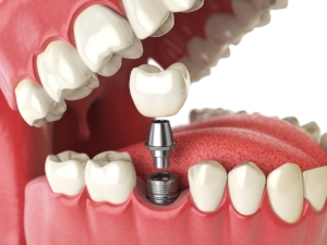 Single tooth implant.
