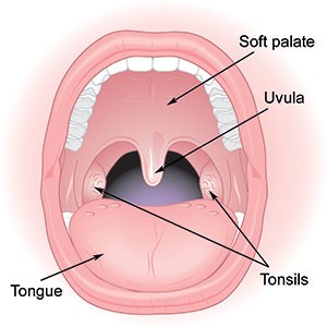 Look for clear spots or streaks of white pus on your tonsils (credit: myclevelandclinic.org ).