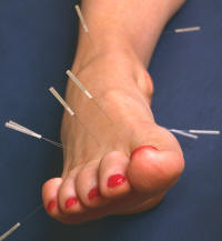 Acupuncture-feet.jpg