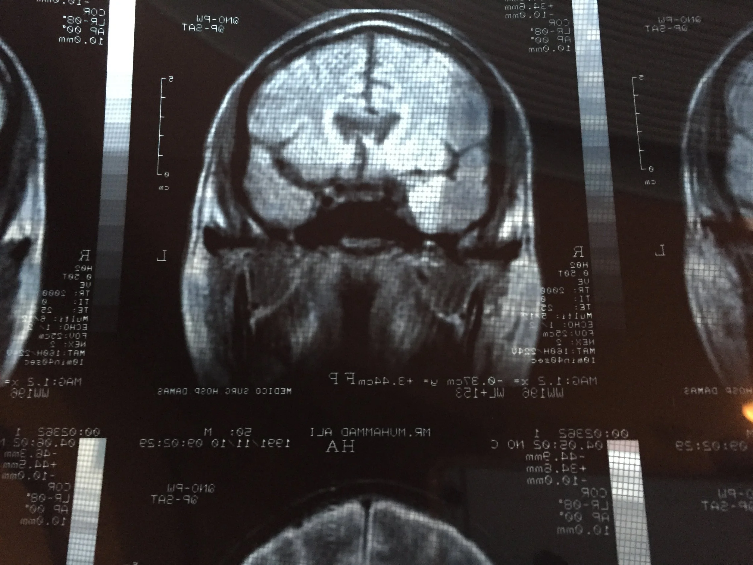Ep. 8 - Counting Every Punch: Muhammad Ali’s Traumatic Brain Injury