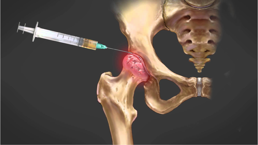 Alternatives to Hip Replacement Surgery — Regenerative Medicine Specialists  of NYC & NJ