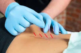 Dry Needling is better than "classic physical therapy" for Chronic Low Back Pain
