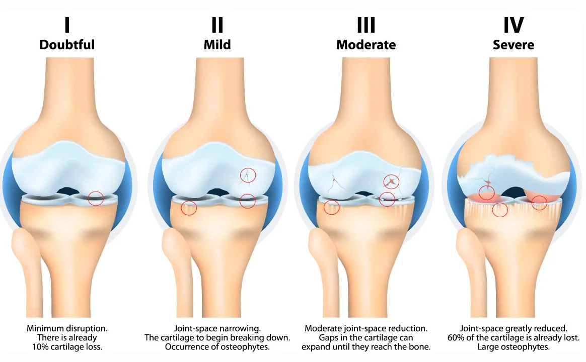 Chingford Study: Osteoarthritis and Metabolic Factors