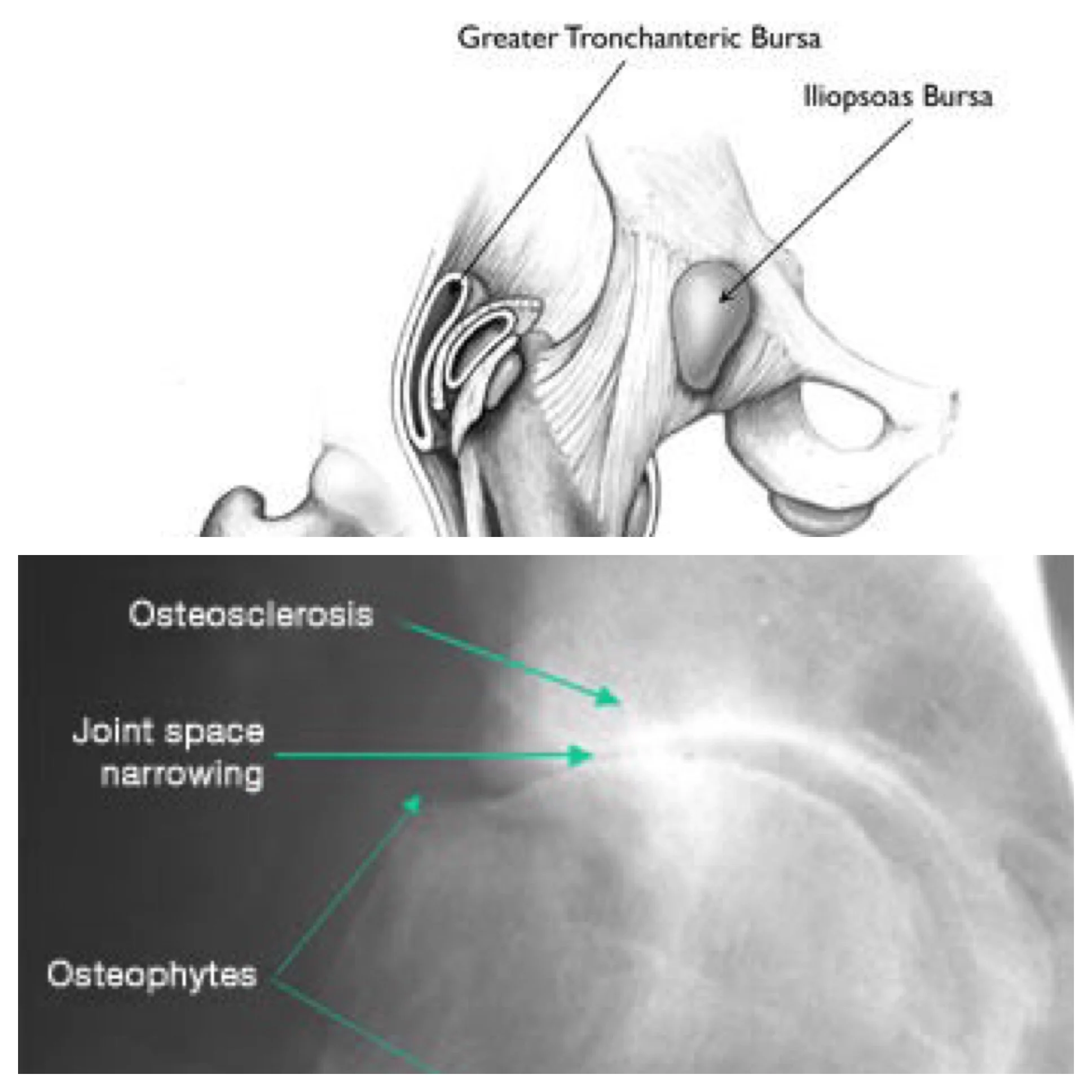 Greater Trochanteric Pain Syndrome vs Hip Osteoarthritis 