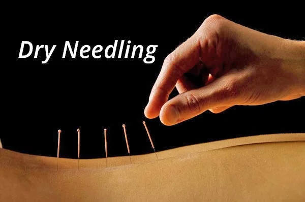 Dry Needling Can Improve Your Abs