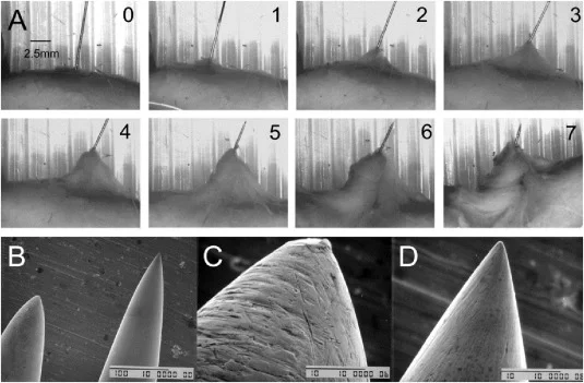 Dry Needling Fascial Winding for Carpal Tunnel