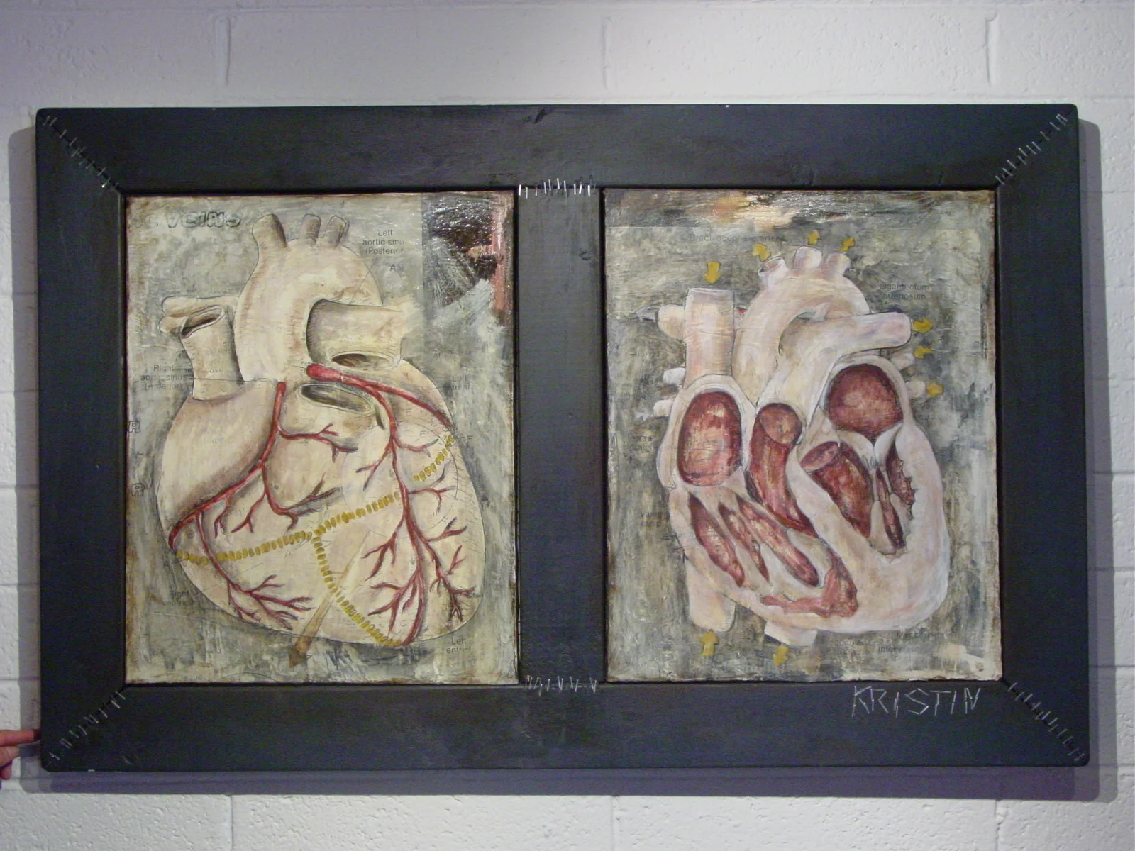 Heart Attack