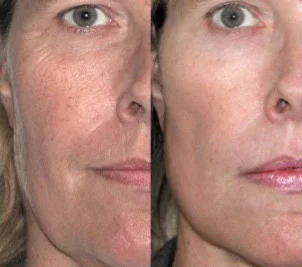 ipl+photofacial+dermaenvy.jpg