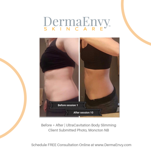 Body Contouring + Sculpting Treatments — DermaEnvy Skincare  Medical  Aesthetics , Laser Hair Removal and Skin Care Clinic