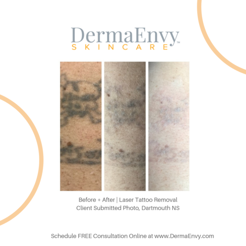 Laser Tattoo Removal | Remove or Fade Unwanted Tattoos — DermaEnvy Skincare  | Medical Aesthetics , Laser Hair Removal and Skin Care Clinic