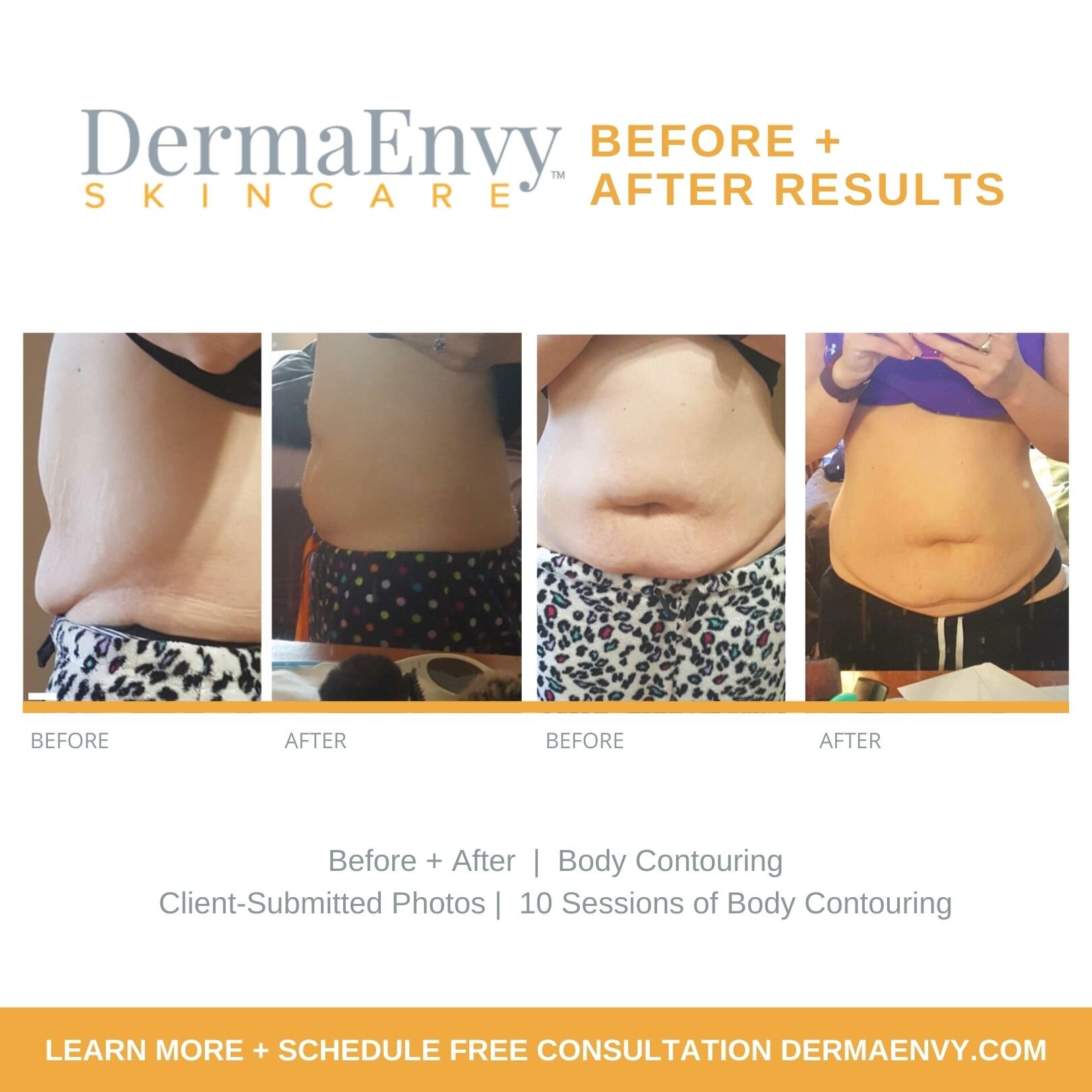 Body Contouring + Sculpting Treatments — DermaEnvy Skincare