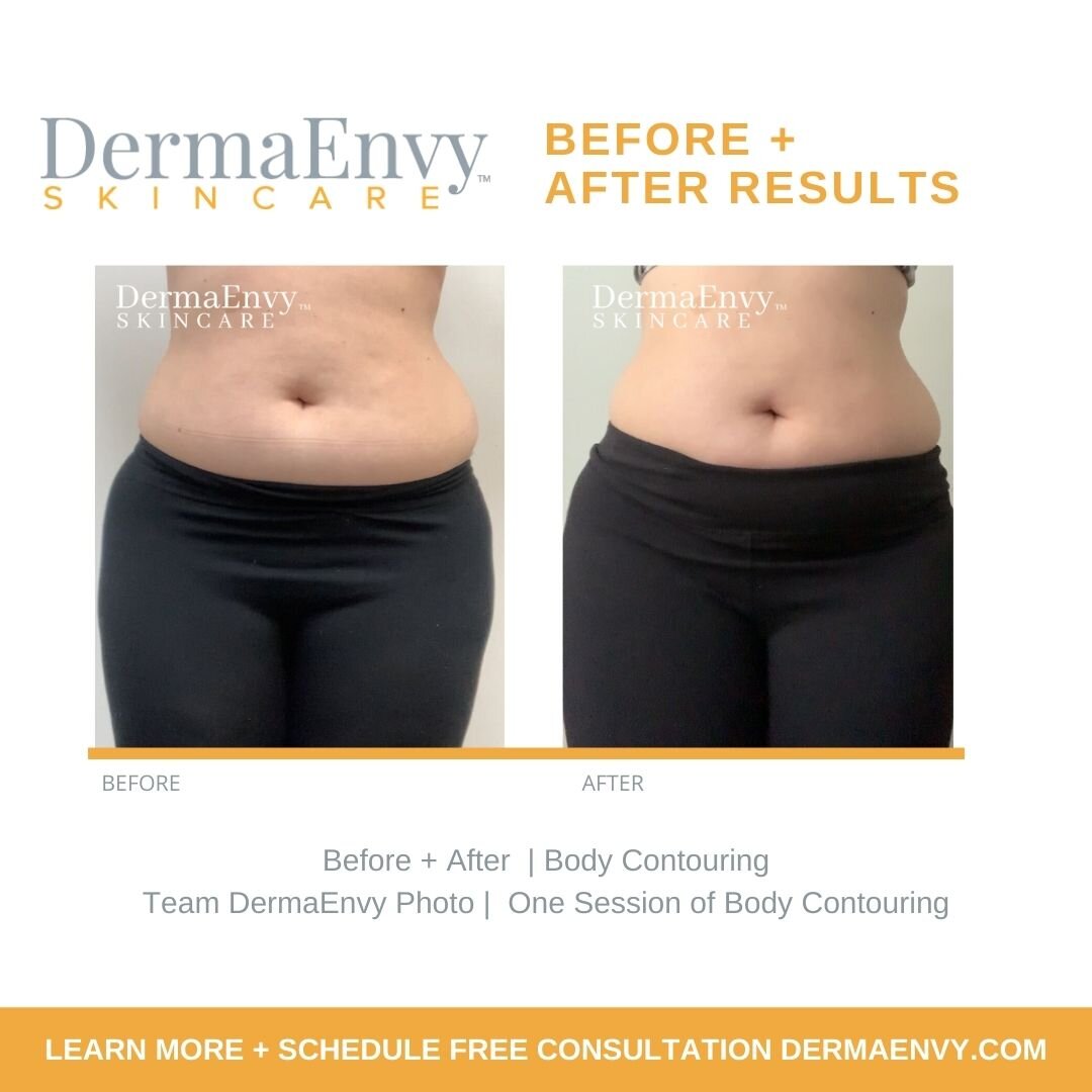 Body Contouring + Sculpting Treatments — DermaEnvy Skincare  Medical  Aesthetics , Laser Hair Removal and Skin Care Clinic