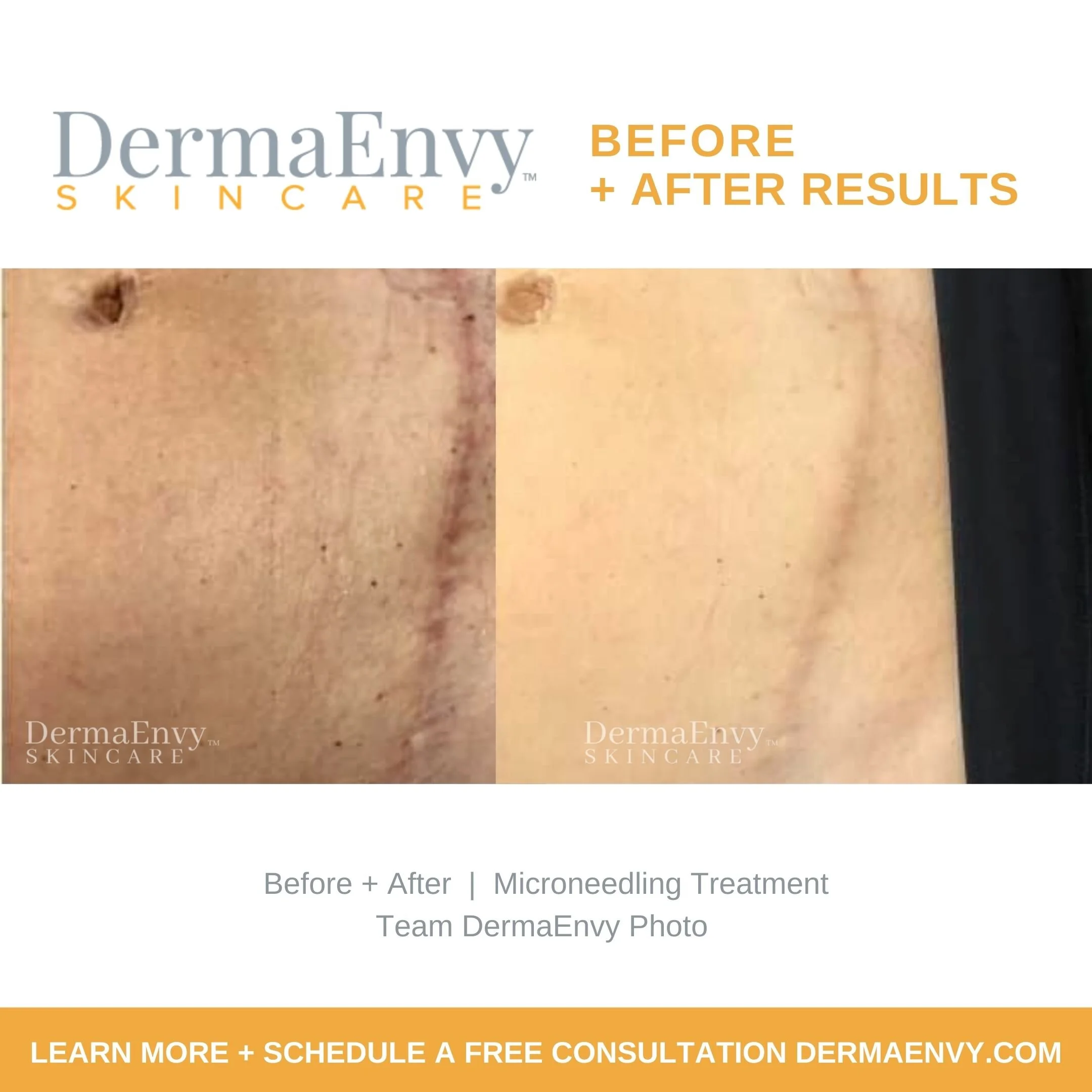 Microneedling near me Skin Needling Facial Dermapen Treatments