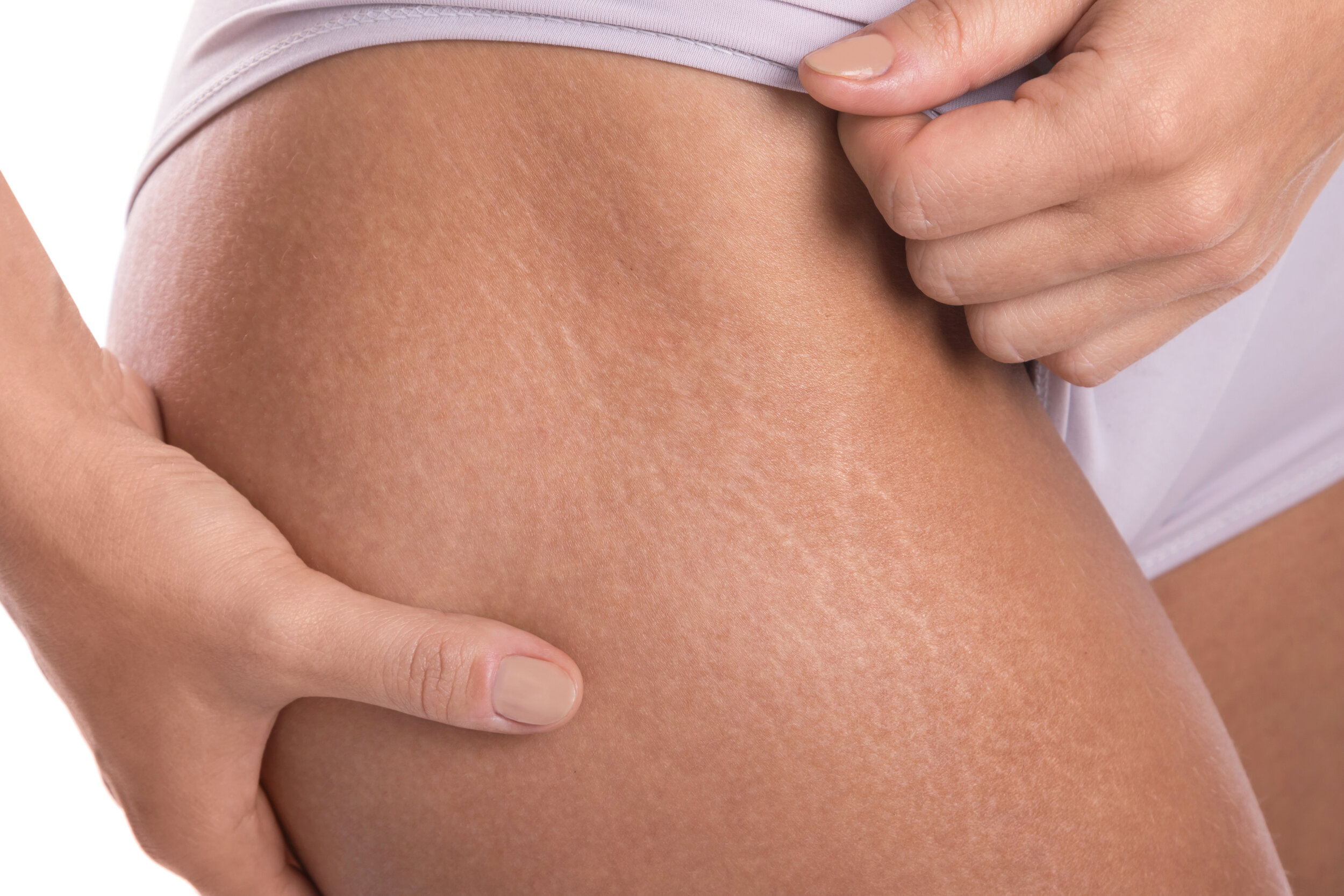 Stretch Mark Treatment Helps to Fade and Eliminate — DermaEnvy Skincare