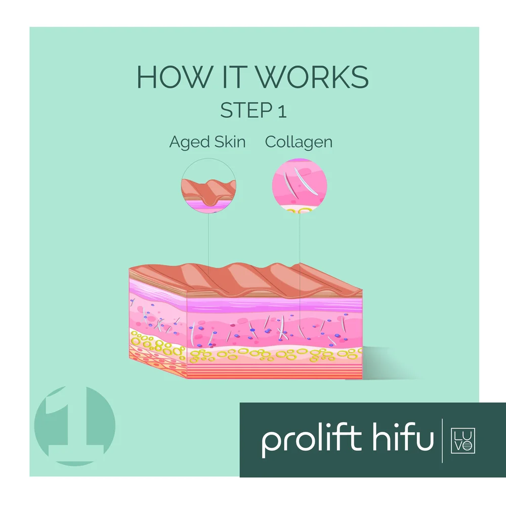 PROLIFT+HIFU_How+It+Works.jpg?format=100